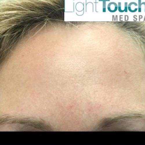 Forehead after botox treatment