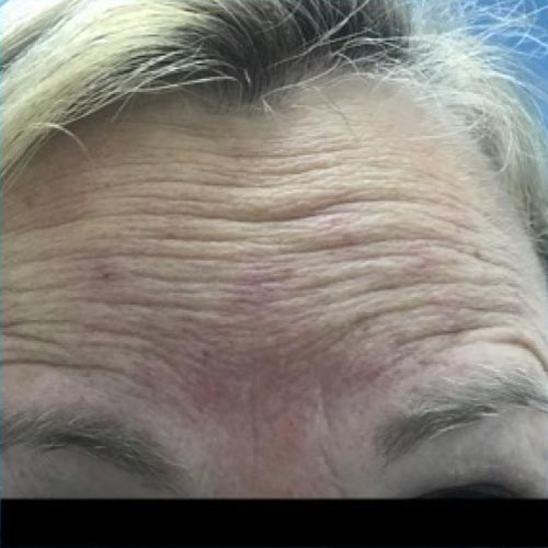 Forehead before botox treatment