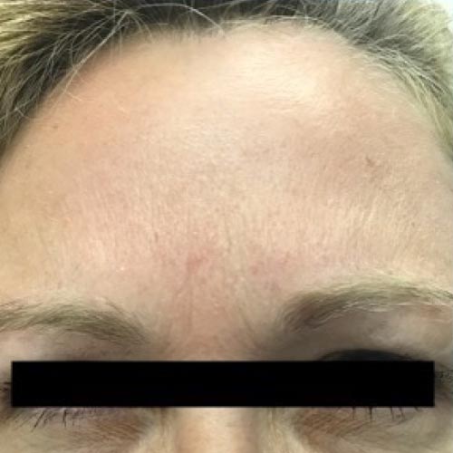 Forehead after botox treatment