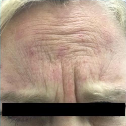 Forehead before botox treatment