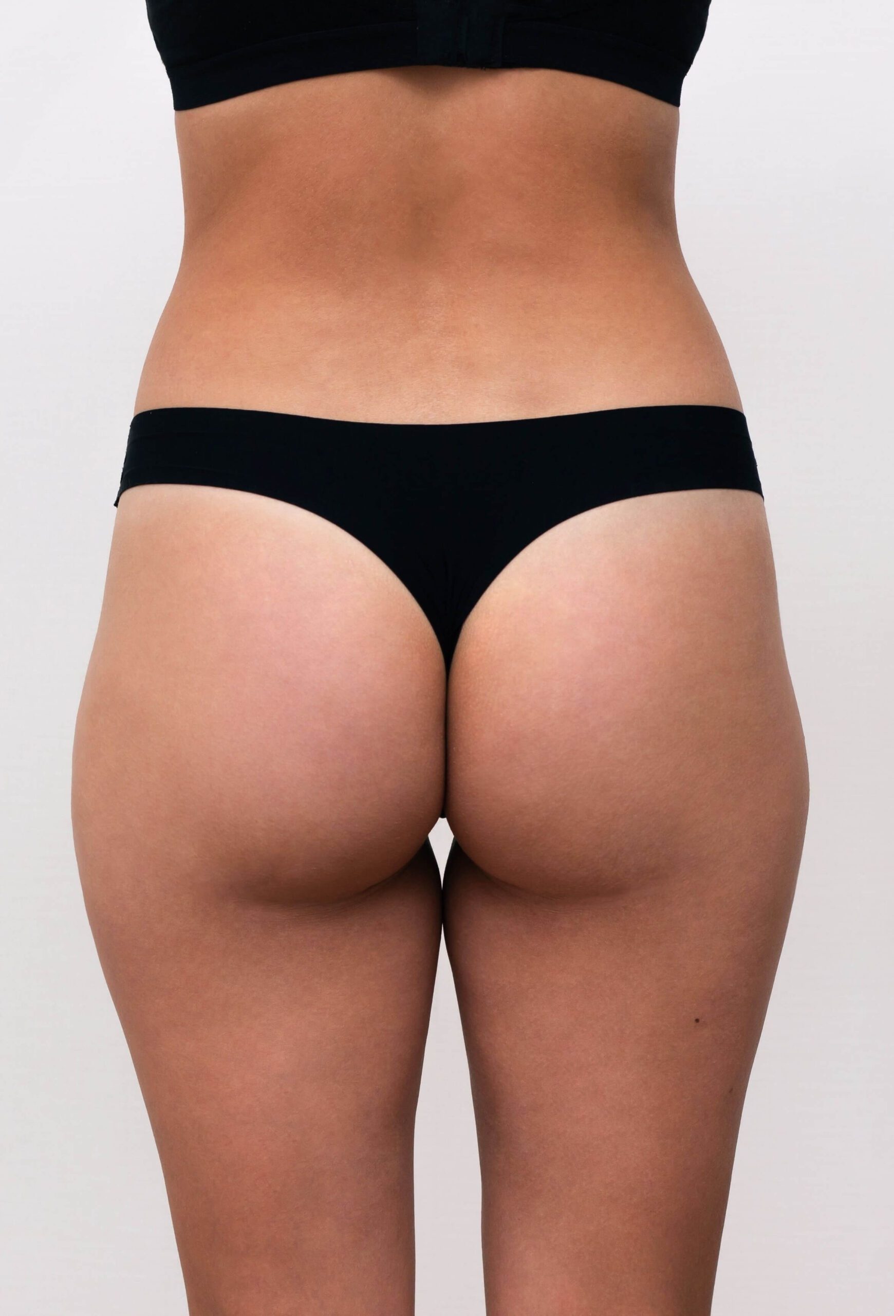 cellulite bbl after 1 | LightTouch Med Spa