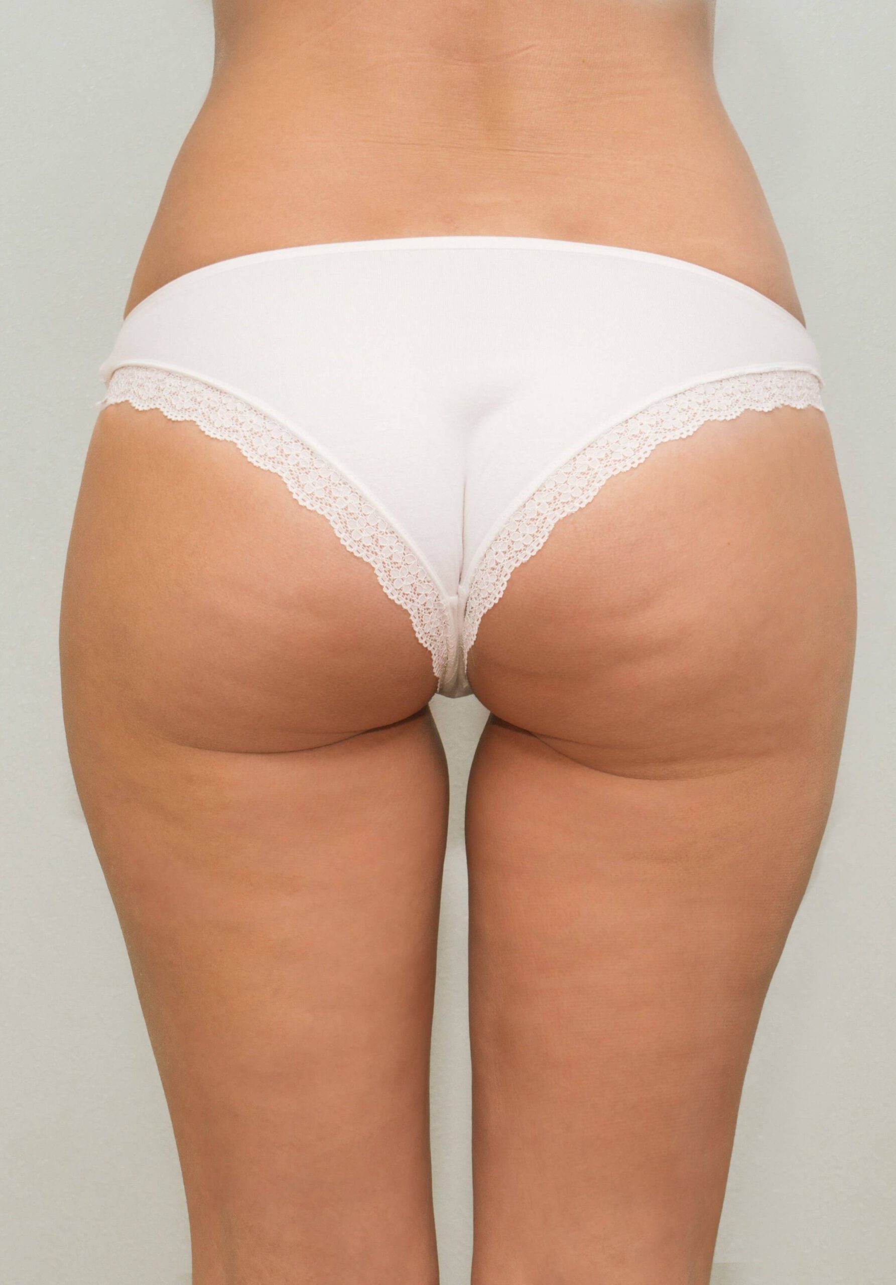 cellulite bbl before 1 1 | LightTouch Med Spa