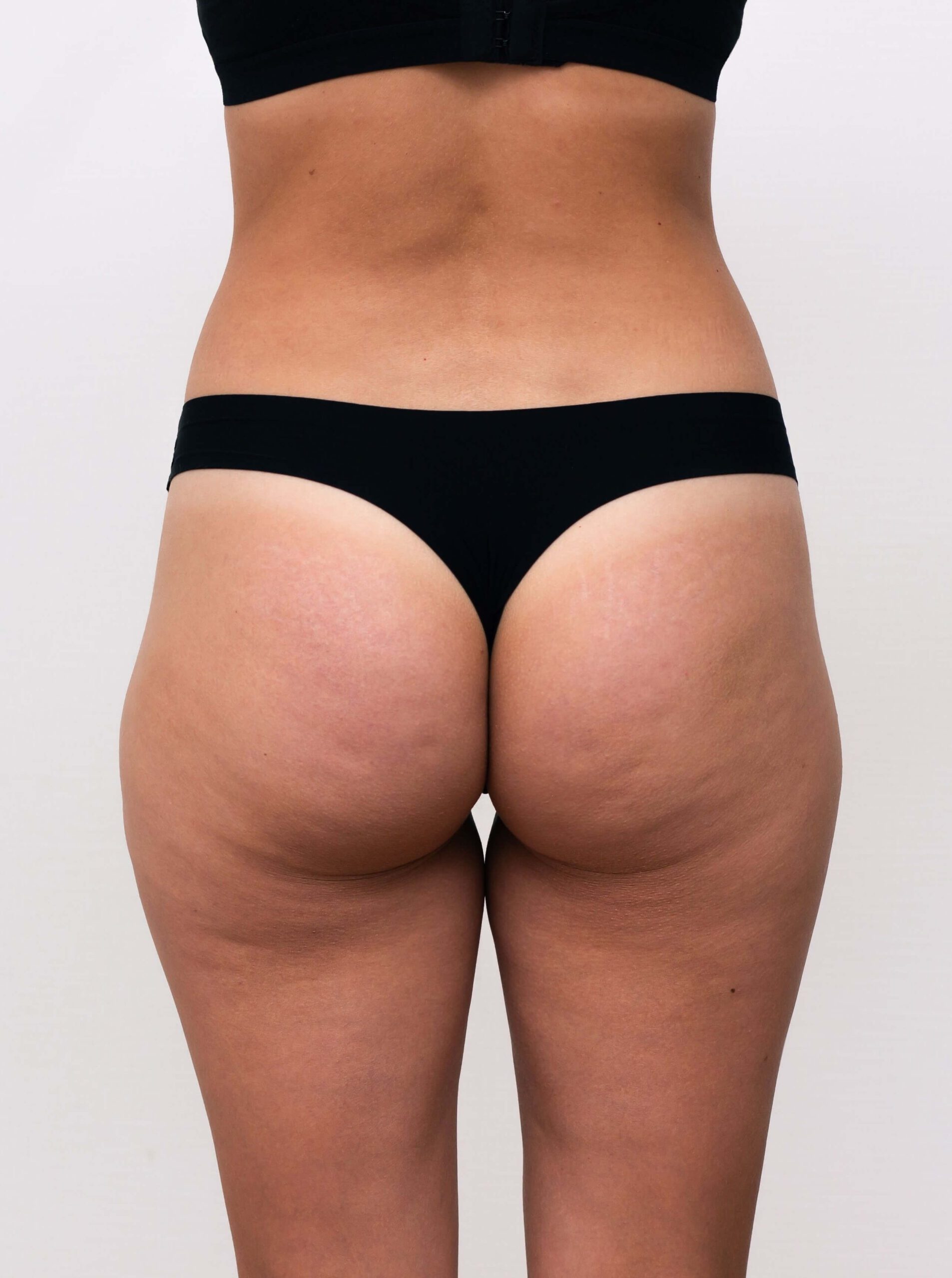 cellulite bbl before 1 | LightTouch Med Spa