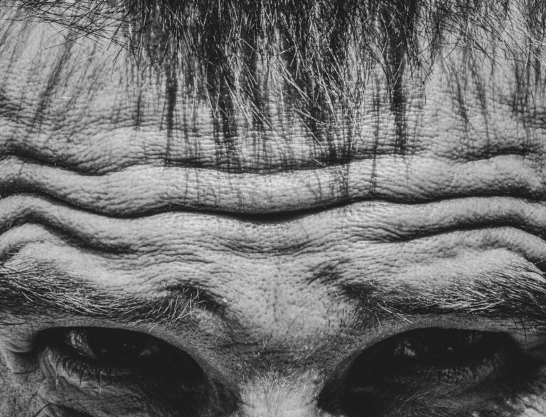 Nurse injector marking frown lines before treating with 20 units of Botox