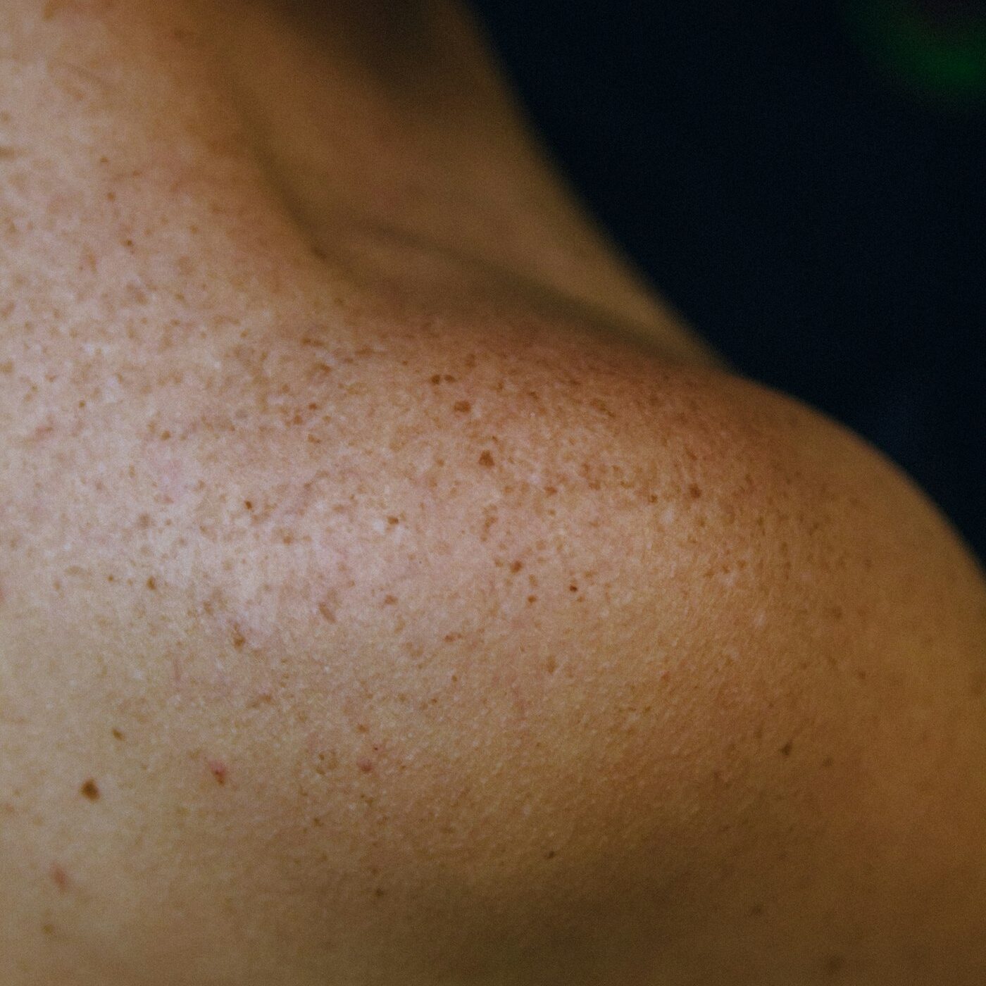 Sun damage and brown spots on the shoulder before IPL photofacial Sun damage and brown spots on the shoulder before IPL photofacial